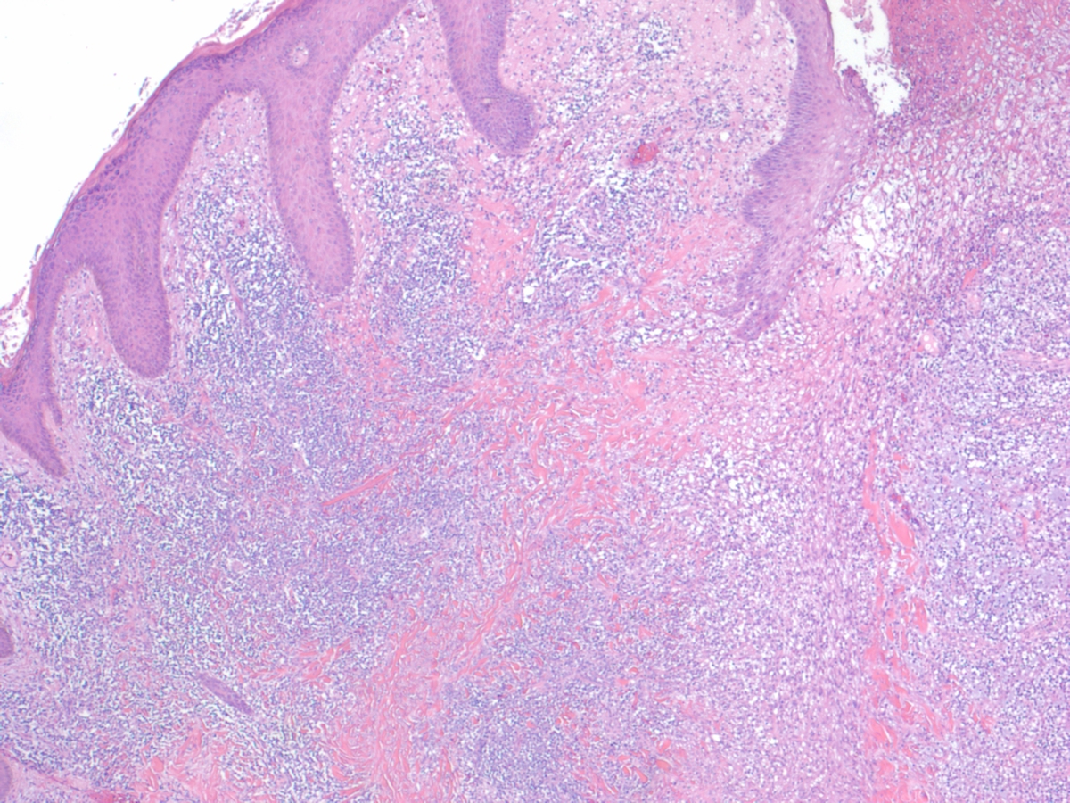 Skin Biopsy: H and E stain, 40x